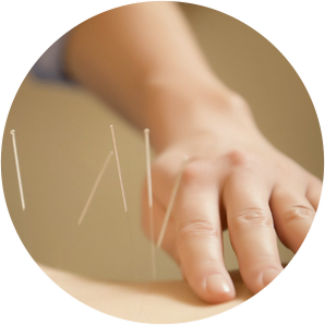 Acupuncture